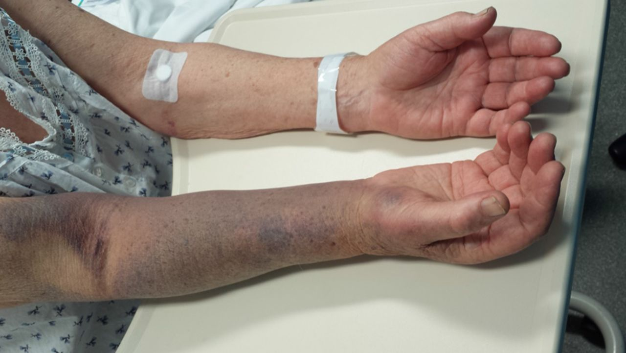 What to Know About Elderly Bruising