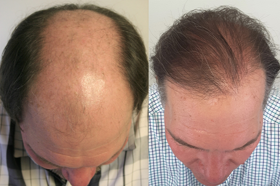 Important Questions on Your First Hair Transplant Consultation