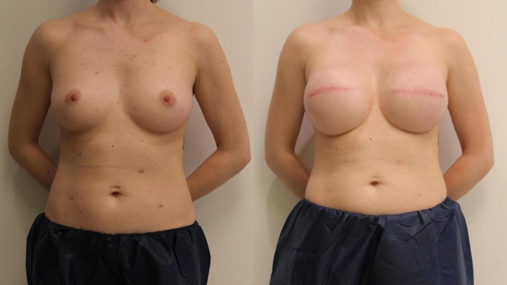 Effective Breast Reconstructive Surgery in East Windsor, NJ