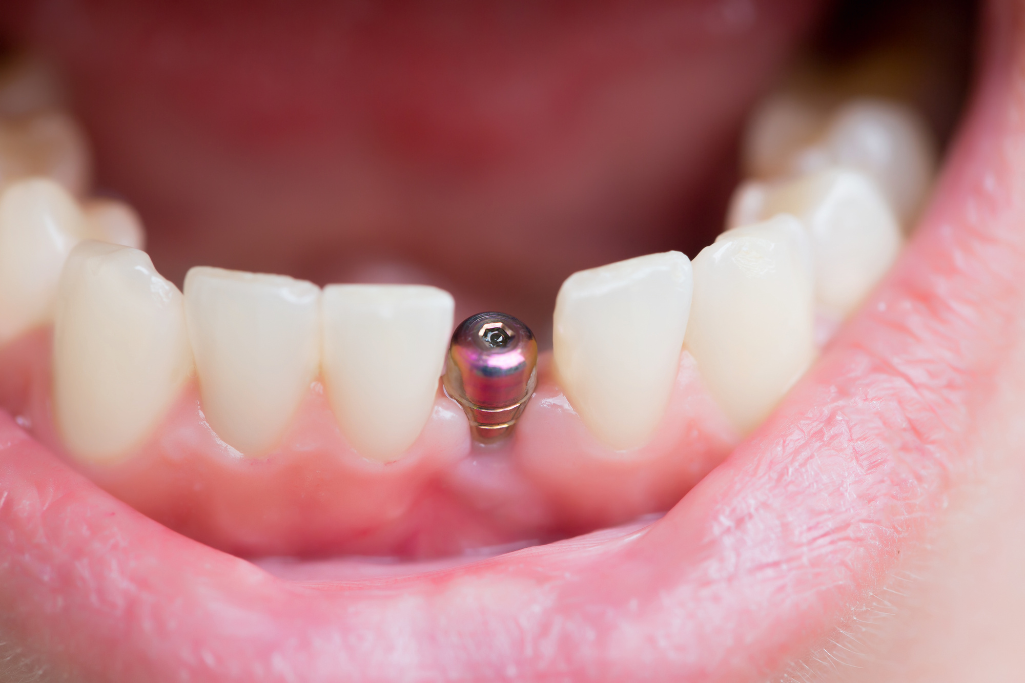 Understanding Dental Implant Procedure- What to Expect